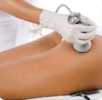 Radiofrequência - Corpo